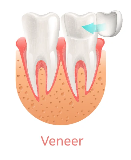 VeneersPLD